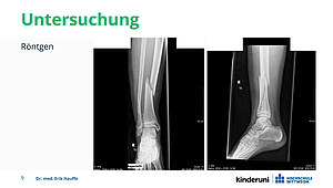 Das sieht man sofort: Gleich beide Unterschenkelknochen sind gebrochen – Schienbein und Wadenbein.